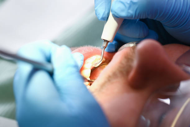 Best Chipped Tooth Repair Near Me  in Laurel, MT
